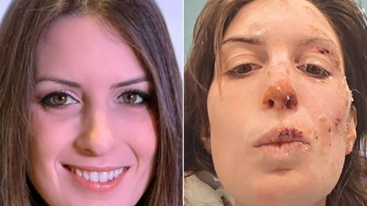 Une survivante de Crans-Montana dévoile son visage brûlé et son message d'espoir